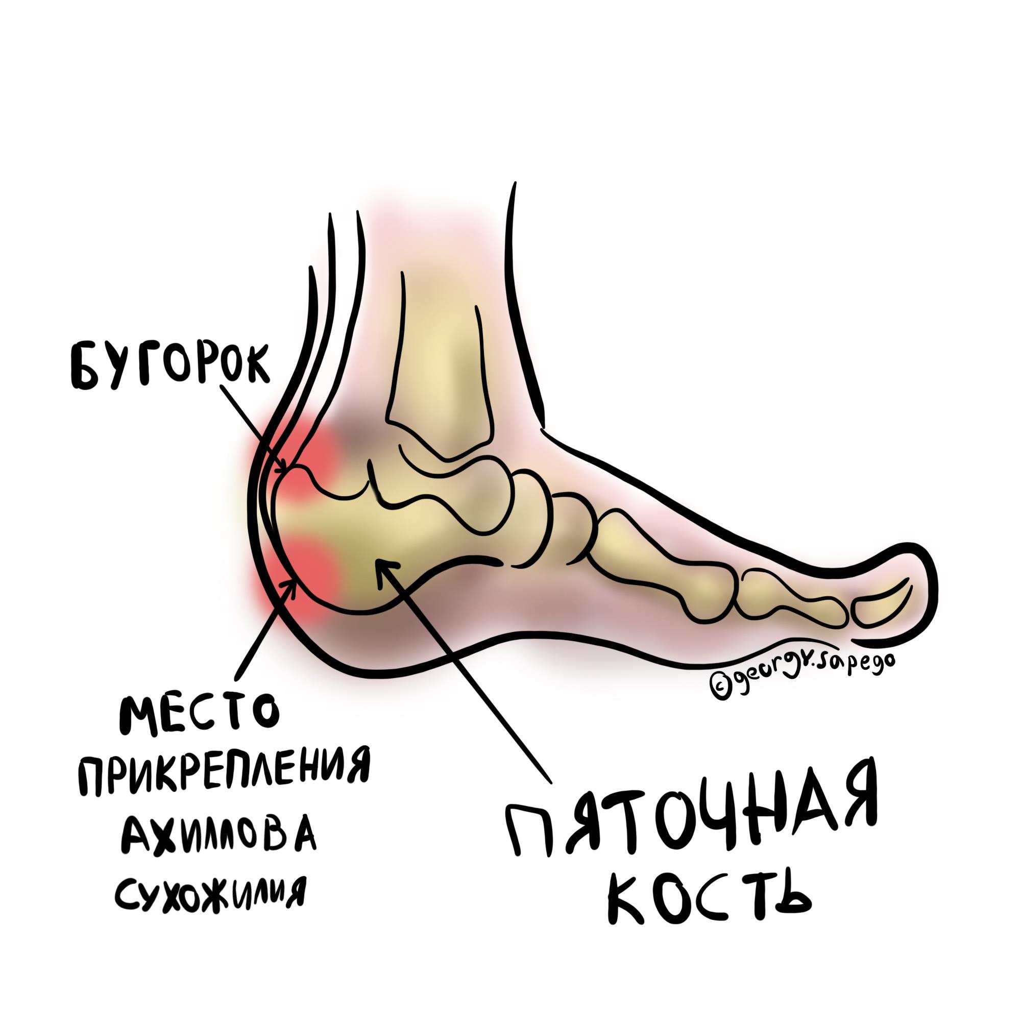 Болит кость выше пятки сзади